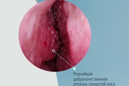 Нижегородский врач обнаружил у пациента редкую и загадочную опухоль