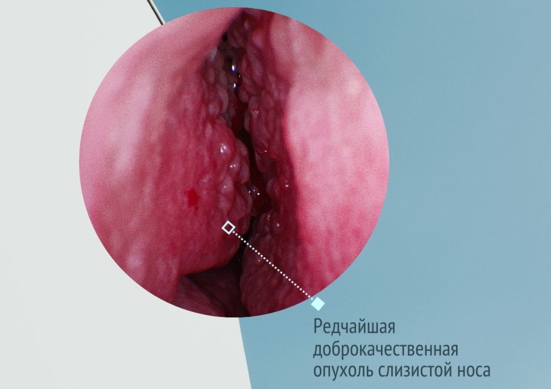 Нижегородский врач обнаружил у пациента редкую и загадочную опухоль - фото 1