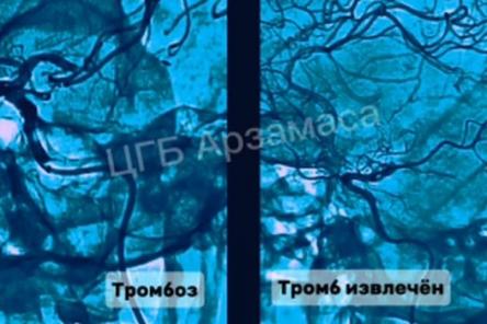 Нижегородские врачи спасли мозг пациента от тромбоза