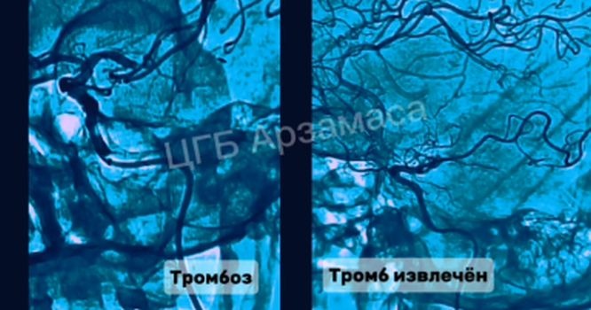 Нижегородские врачи спасли мозг пациента от тромбоза - фото 1